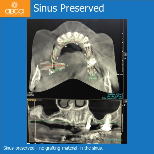 Oro-antral Communication Closure