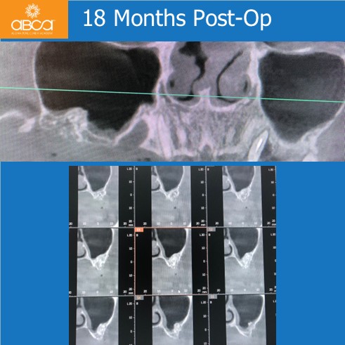 Oro-antral Communication Closure