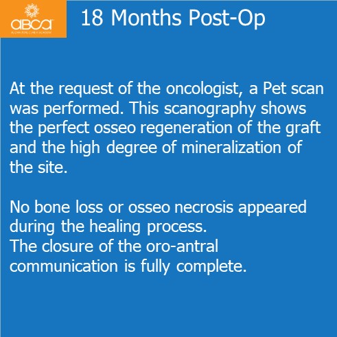 Oro-antral Communication Closure