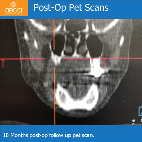 Oro-antral Communication Closure