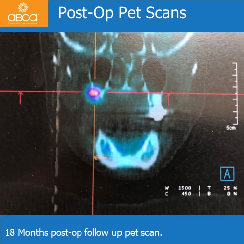 Oro-antral Communication Closure