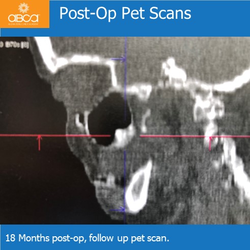 Oro-antral Communication Closure