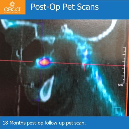 Oro-antral Communication Closure