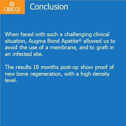 Oro-antral Communication Closure