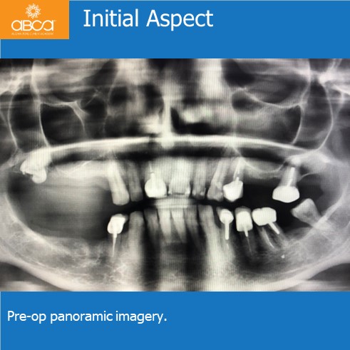 Oro-antral Communication Closure