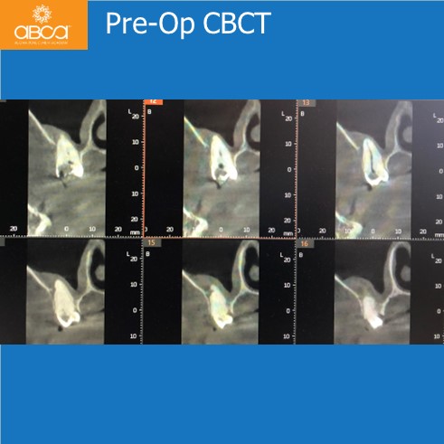 Oro-antral Communication Closure