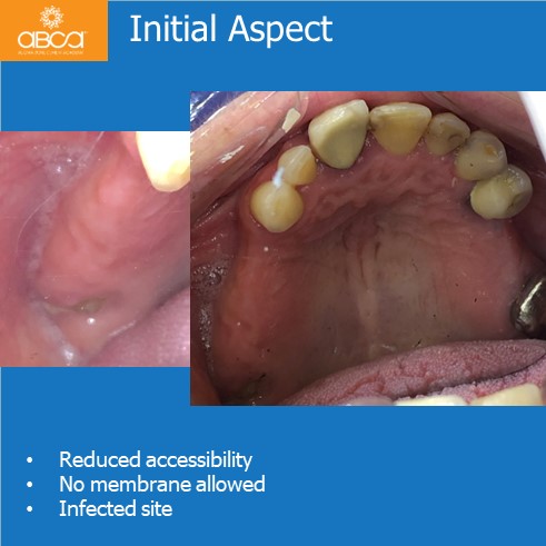 Oro-antral Communication Closure