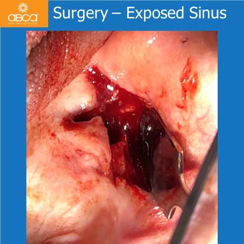 Oro-antral Communication Closure