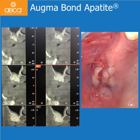 Oro-antral Communication Closure