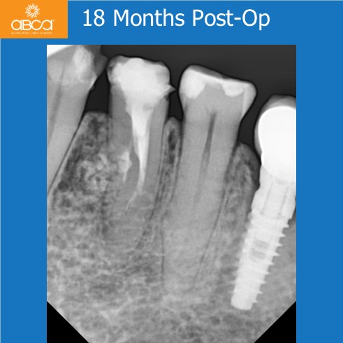 Complications in Endo Treatment – Root Canal Perforation #35 (20)