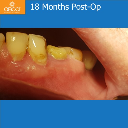 Complications in Endo Treatment – Root Canal Perforation #35 (20)