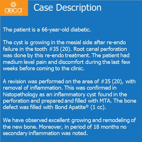 Complications in Endo Treatment – Root Canal Perforation #35 (20)