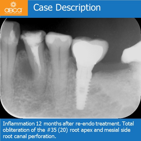 Complications in Endo Treatment – Root Canal Perforation #35 (20)