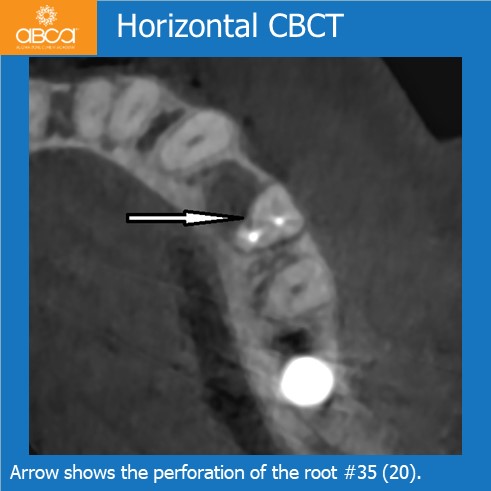 Complications in Endo Treatment – Root Canal Perforation #35 (20)