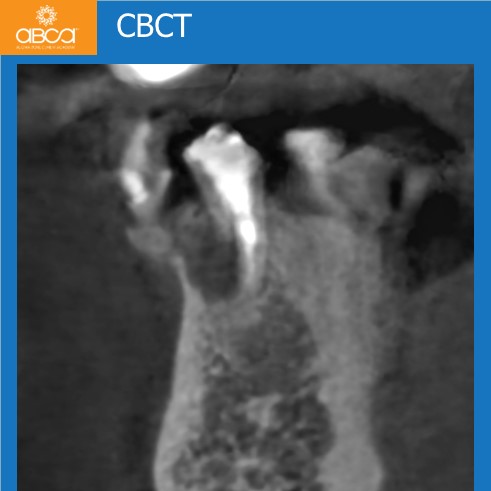 Complications in Endo Treatment – Root Canal Perforation #35 (20)