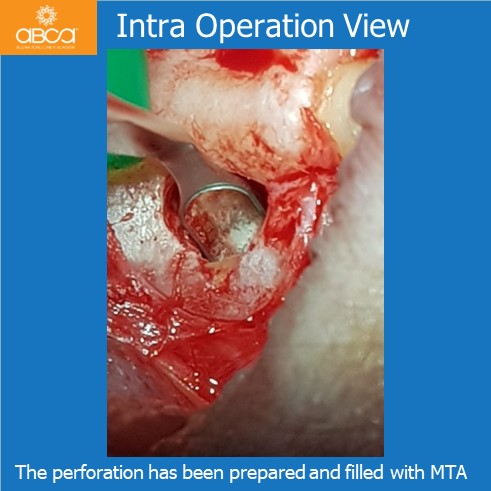 Complications in Endo Treatment – Root Canal Perforation #35 (20)