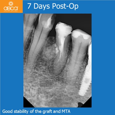 Complications in Endo Treatment – Root Canal Perforation #35 (20)